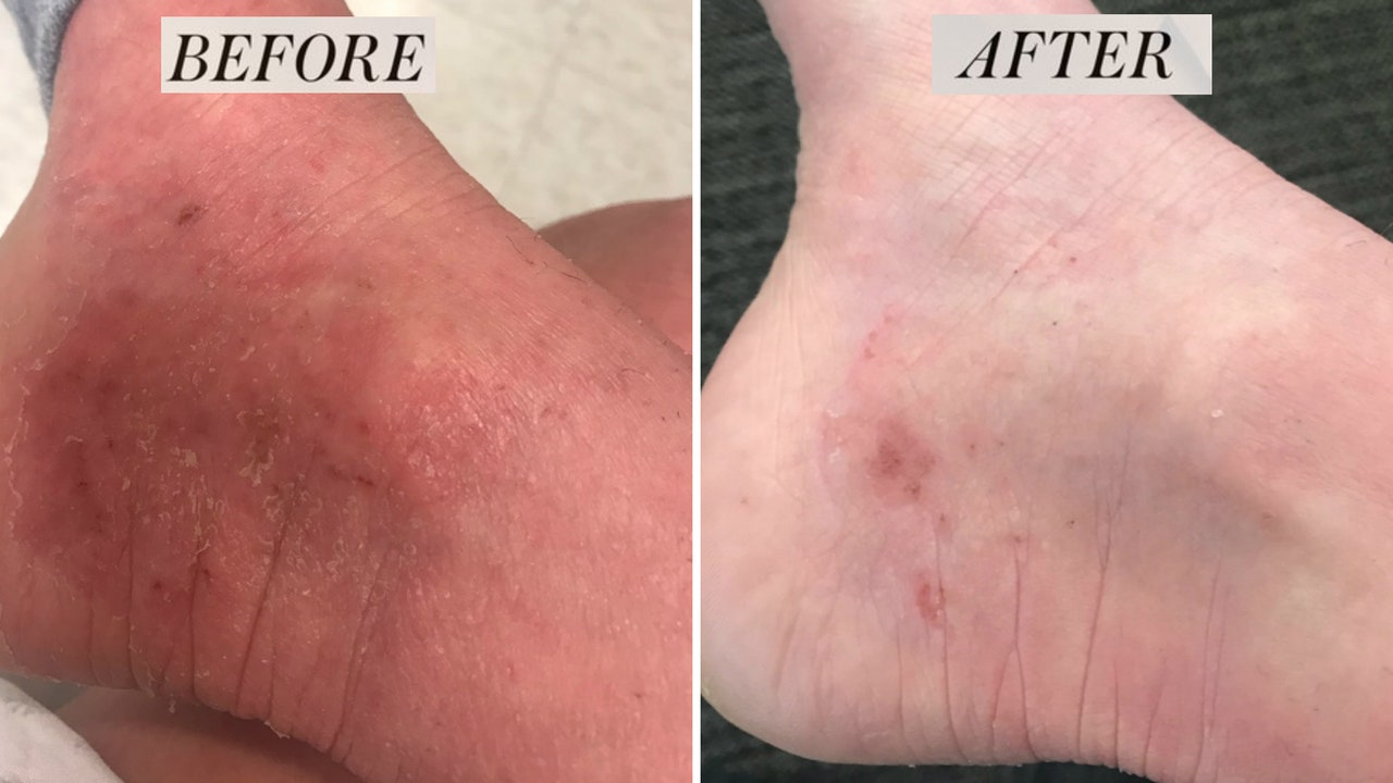 I Used Urea Cream to Exfoliate My Dry, Cracked Feet and It Worked Wonders